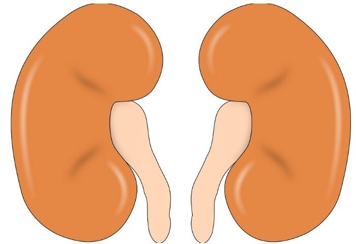 Natural remedies for kidney stone